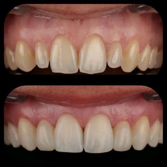 Image of two smiles showing how treatments could improve the teeth